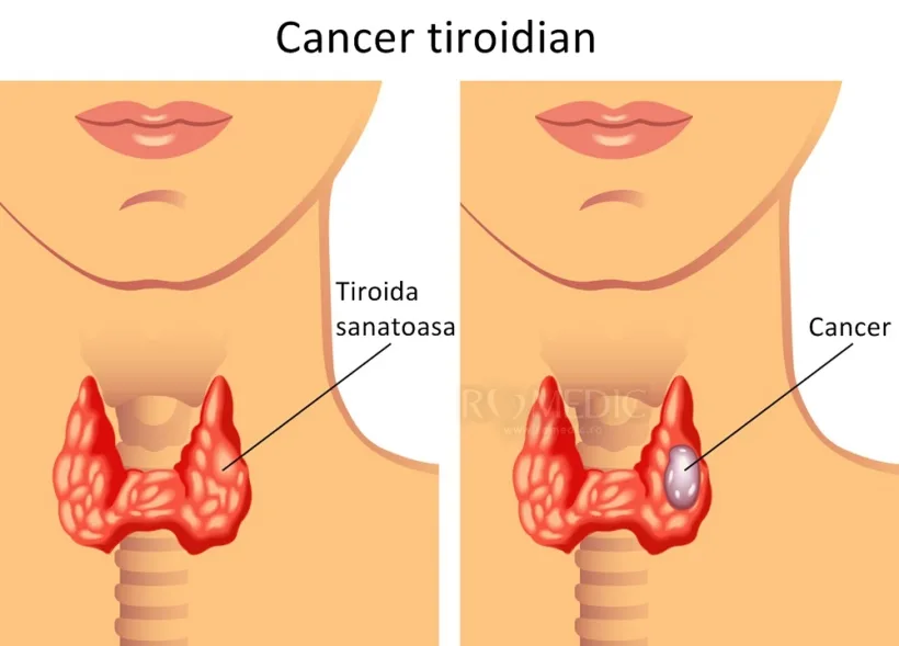 Cancerul tiroidian, o afecţiune tot mai des întâlnită în ultimii 50 de ani