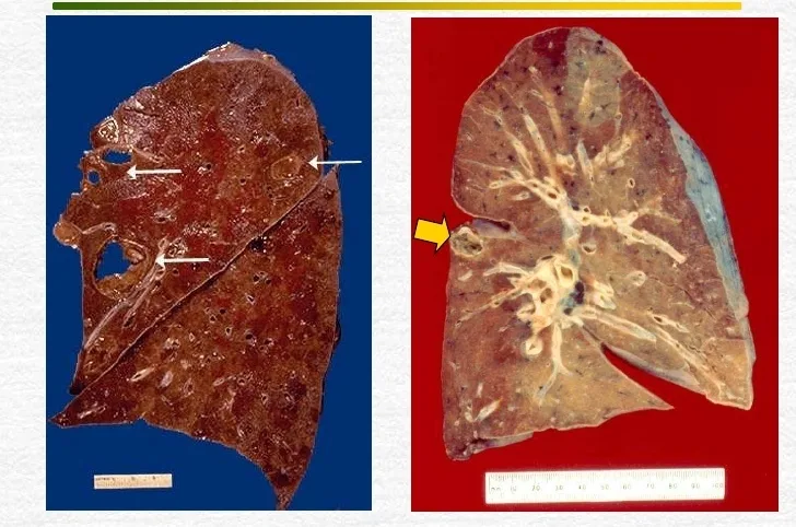 Abcesul pulmonar