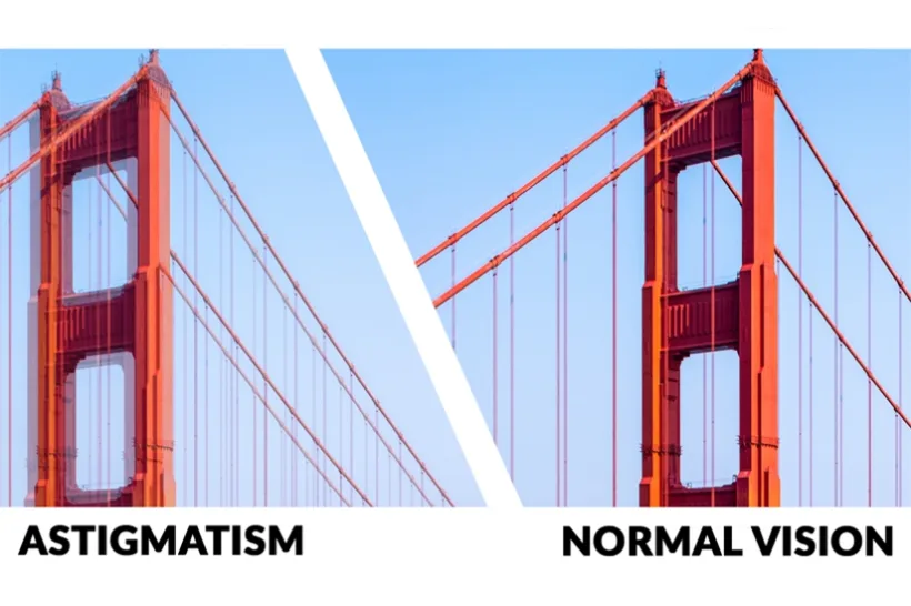 Astigmatismul