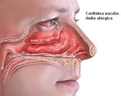 Rinita alergică