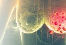 O nouă abordare în tratamentul cancerului de sân