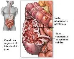 Ghid actualizat pentru boala Cohn