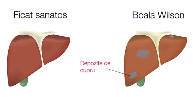 O boală ereditară nouă