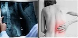 Osteoporoza în atenţia cercetătorilor